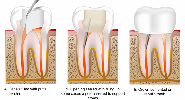Root canal treatment