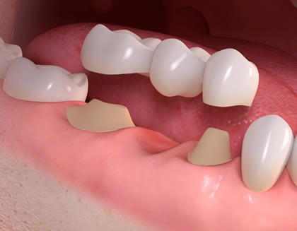 Dental bridge